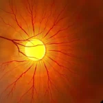 Plamka żółta: Znaczenie, Zwyrodnienie i Leczenie