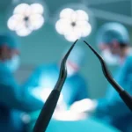 Zabieg na zaćmę: Co warto wiedzieć przed operacją?