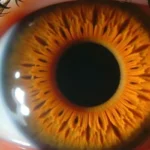 Zaćma słonecznikowa – Objawy, Przyczyny i Leczenie