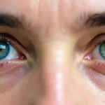 Zaćma – Objawy, Rodzaje i Metody Leczenia