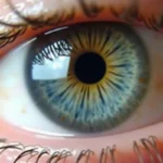 Zaćma wtórna – Objawy, Przyczyny i Metody Leczenia